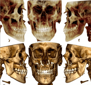 chirurgia ortognatica e asimmetria facciale