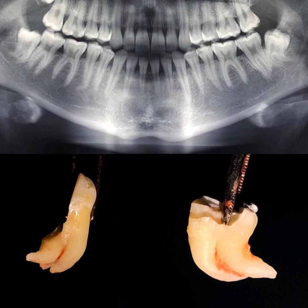 denti del giudizio inclusi