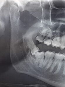 estrazione denti giudizio radiografia