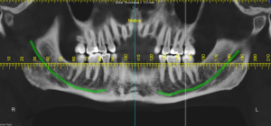 nervo mandibolare radiografia