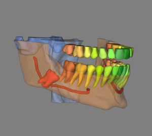 quando estrarre il dente del giudizio inferiore