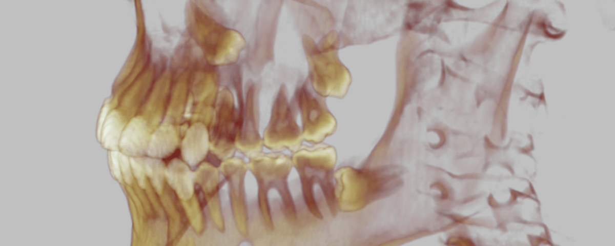 dente del giudizio 3d traparente