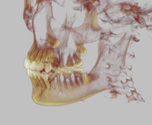 dente del giudizio 3d traparente
